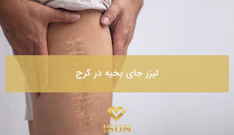 لیزر جای بخیه در کرج بهترین جا کجاست؟ - کلینیک آیسان