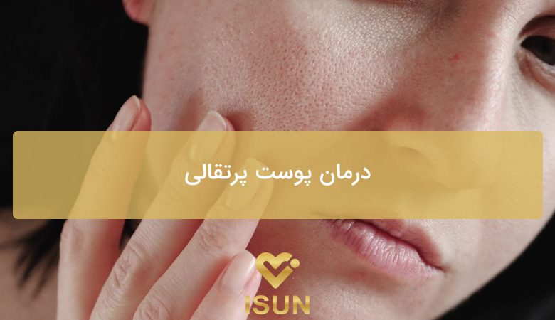 درمان پوست پرتقالی صورت با لیزر