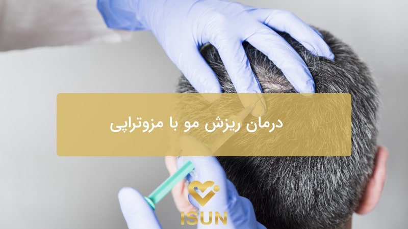 درمان ریزش مو با مزوتراپی در کرج