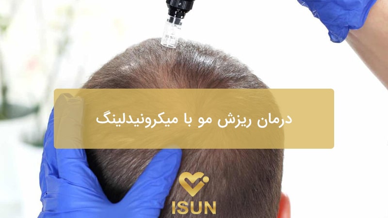 درمان ریزش مو با میکرونیدلینگ در کرج